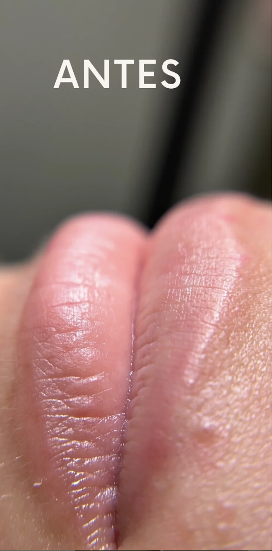 Tratamiento de Labios — antes