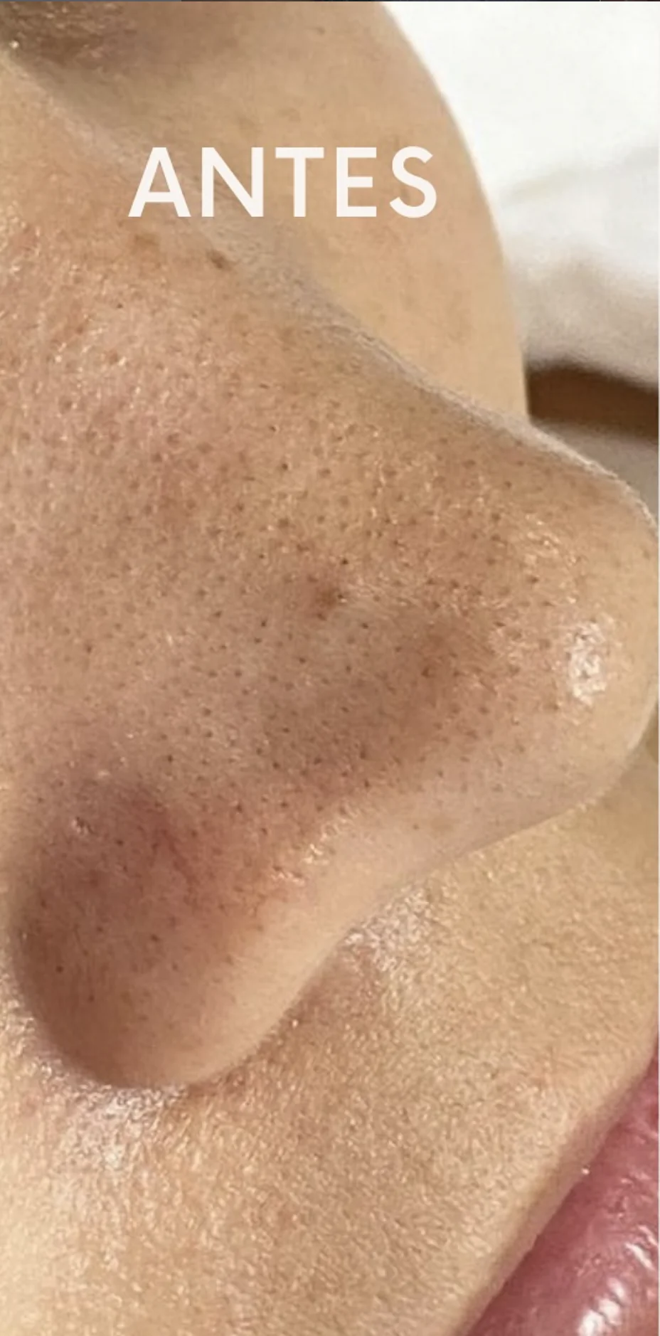 Limpieza Facial Profunda — antes
