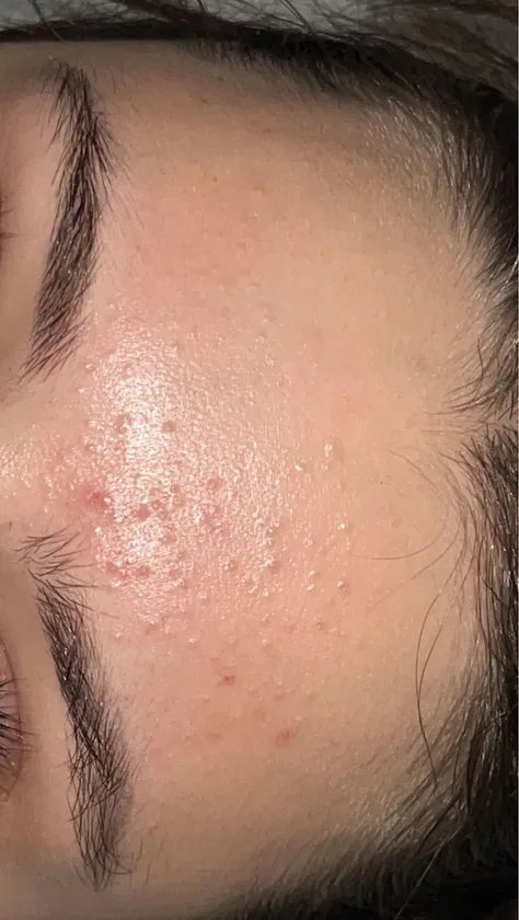 Acne Comedogenico — tratamiento facial Alpot Studio
