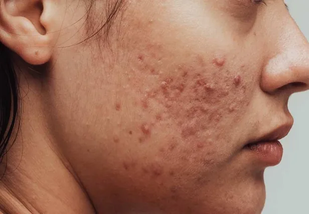 Exosomas Acne — tratamiento facial Alpot Studio