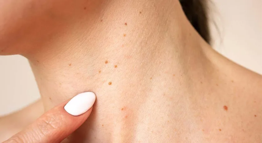 Remocion Verrugas — tratamiento facial Alpot Studio