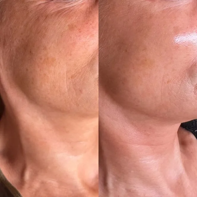 Crystal Laser — tratamiento Alpot Studio