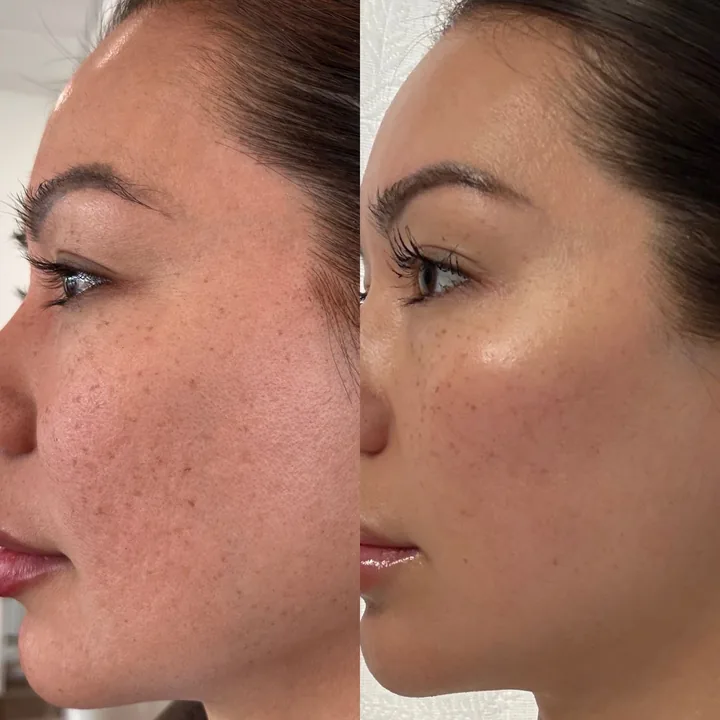 Crystal Laser — detalle de zona tratada
