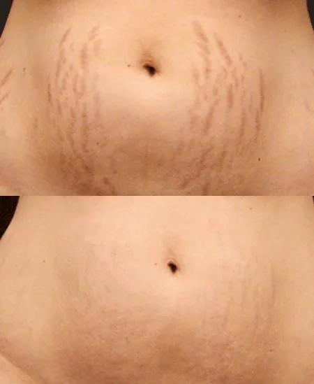 Plasma Fibroblast — detalle de zona tratada