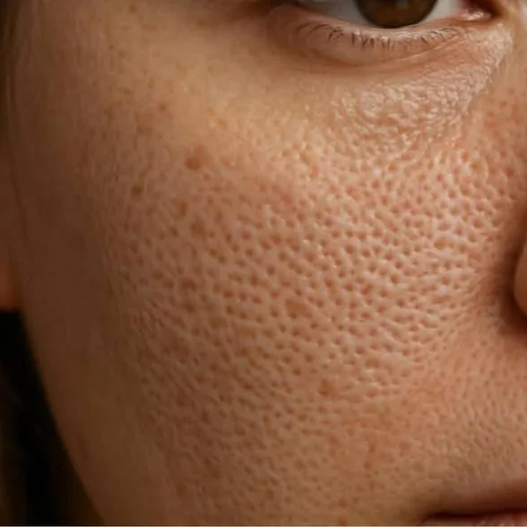 Thulium Laser — tratamiento Alpot Studio