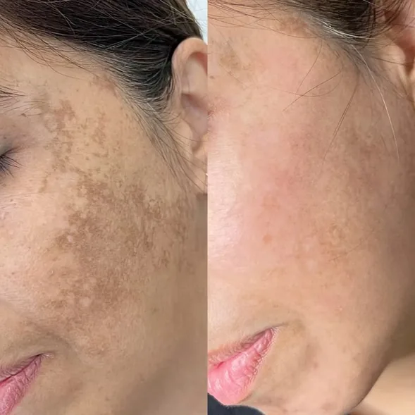 Thulium Laser — tratamiento Alpot Studio