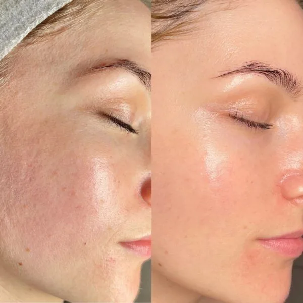 Thulium Laser — tratamiento Alpot Studio