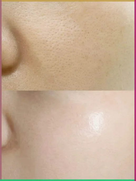 Thulium Laser — detalle de zona tratada